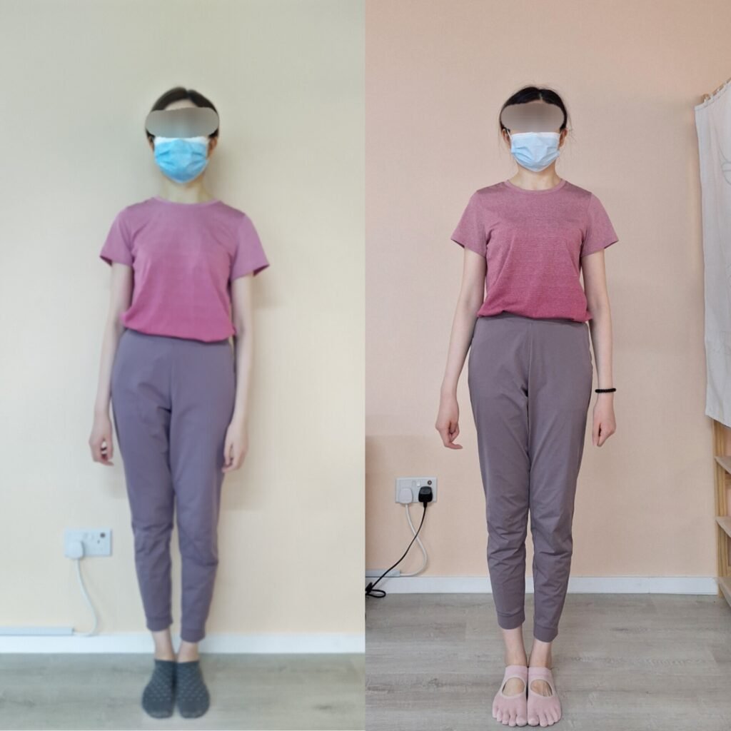 普拉提改善脊椎側彎